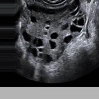 Dataset-cyst-sop-parte-2 project thumbnail