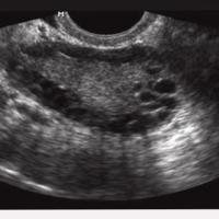 PCOS Detection project thumbnail