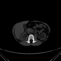 Kidney Stone detection project thumbnail