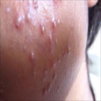 Skin Problems Dataset by Qamar project thumbnail