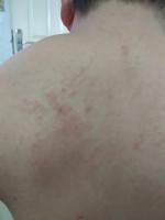 dermatitis project thumbnail