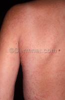 Atopic dermatitis project thumbnail