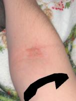 atopic dermatitis 50 img project thumbnail