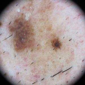 Skin Cancer Classification Model by SkinCancerProject