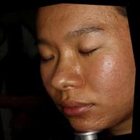 lvl jerawat project thumbnail