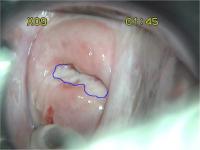 cervical cancer3 project thumbnail