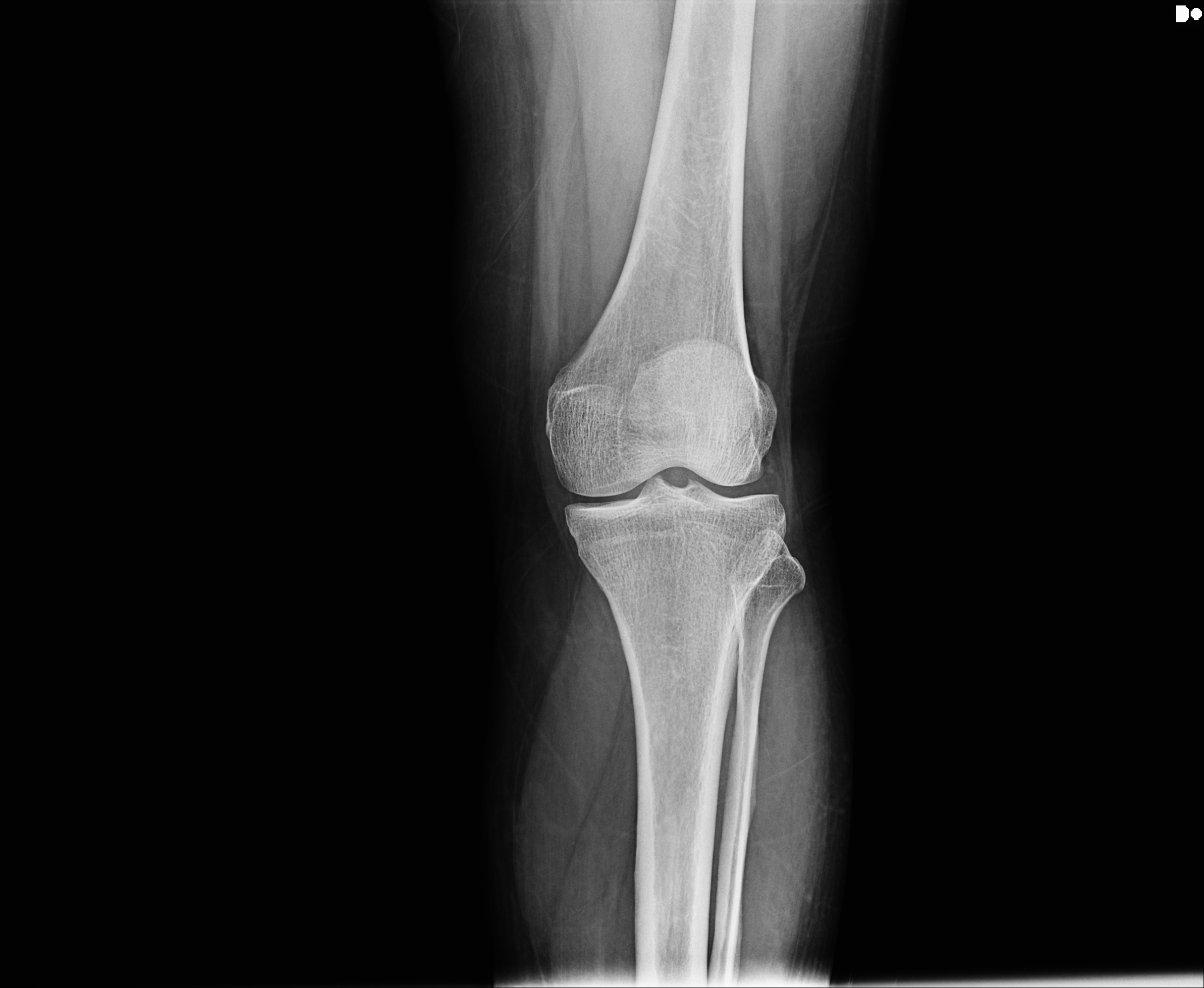 Normal Bone Rx Bones Object Detection Model by Jmi