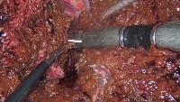 Liver 1 project thumbnail
