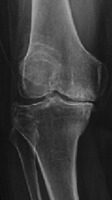 OA Severity Detection project thumbnail