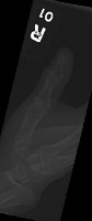 Bone Fracture project thumbnail