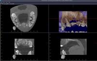 autogenous tooth transplantation project thumbnail