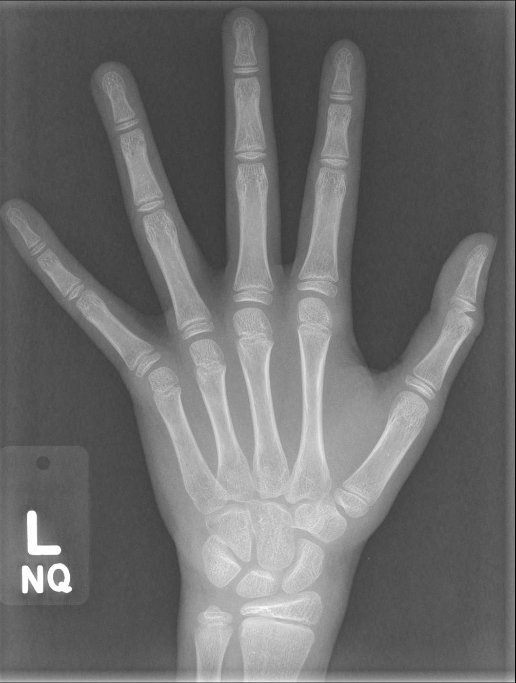 hand bones Object Detection Dataset by yolo