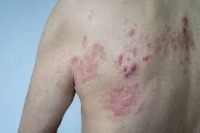 Skin Cancer Classification project thumbnail
