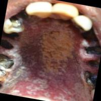 Oral Cancer Detection PKM-KC v2 project thumbnail