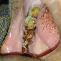 Oral Cancer Detection PKM-KC project thumbnail
