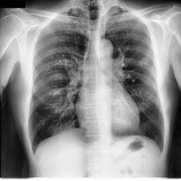 lung1 project thumbnail