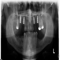 XRAY MODEL AI FOR DENTAL CLINIC  project thumbnail