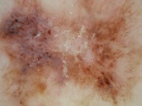 Skin Cancer Object Detection Model by SkinCancerProject