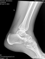 heel bone osteoporosis project thumbnail