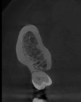 teeth project thumbnail