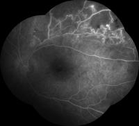 od_macula_seg project thumbnail