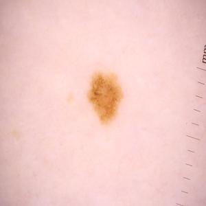 Melanomadetection Object Detection Model By Wayamba