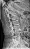 L1-L5 Lumbar Crop project thumbnail
