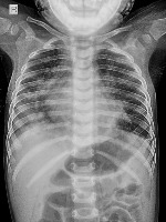 lungs-labelbox project thumbnail