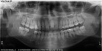 Dental-Xray-Segmentation project thumbnail