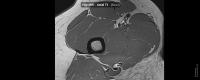 MRI HIP project thumbnail