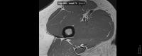 MRI_HIP_1 project thumbnail