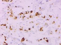 Find cancer cells and cancer cells in browns project thumbnail