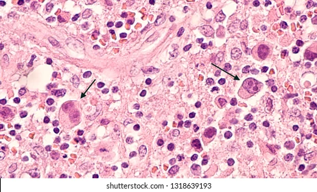 Hodgkin Lymphoma Detector Object Detection Dataset and Pre-Trained ...