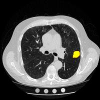 lung_cancer_detection project thumbnail