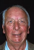 Facial Palsy Classification project thumbnail