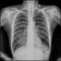 cxr_5_classes_pf project thumbnail
