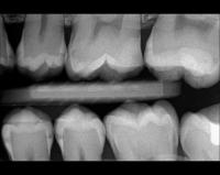 Caries-Detection project thumbnail