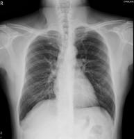 lung project thumbnail