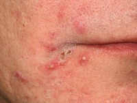 Pimples detection project thumbnail
