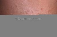 Acne project thumbnail