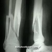 Bone crack project thumbnail