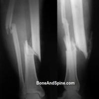 Bone crack project thumbnail