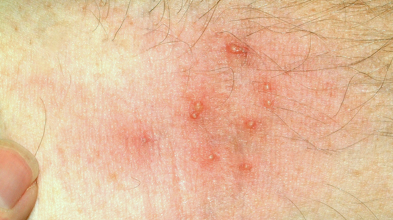 Insect Bite Identifier Roboflow Universe