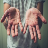 chickenpox-dataset project thumbnail