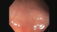Polyps Classification project thumbnail