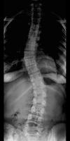 Scoliosis  project thumbnail