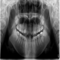 Dental pathology detection model project thumbnail