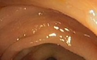 Polyp Detection Dataset project thumbnail