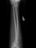 Bone fracture project thumbnail