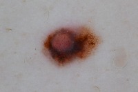 Classification of skin cancer  project thumbnail